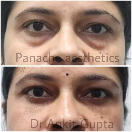 Blepharoplasty result — Lower lid blepharoplasty — before & after